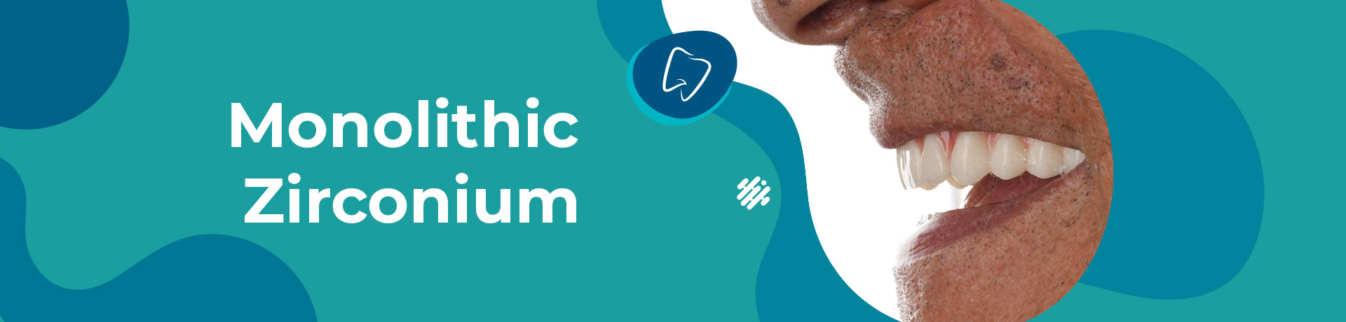 Monolithic zirconium dental veneer is a type of veneer that is made without the use of porcelain on top of zirconium.