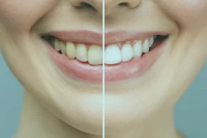 Professional teeth-whitening treatment providing a brighter smile. Achieve whiter teeth with our advanced teeth-whitening solutions for lasting results.