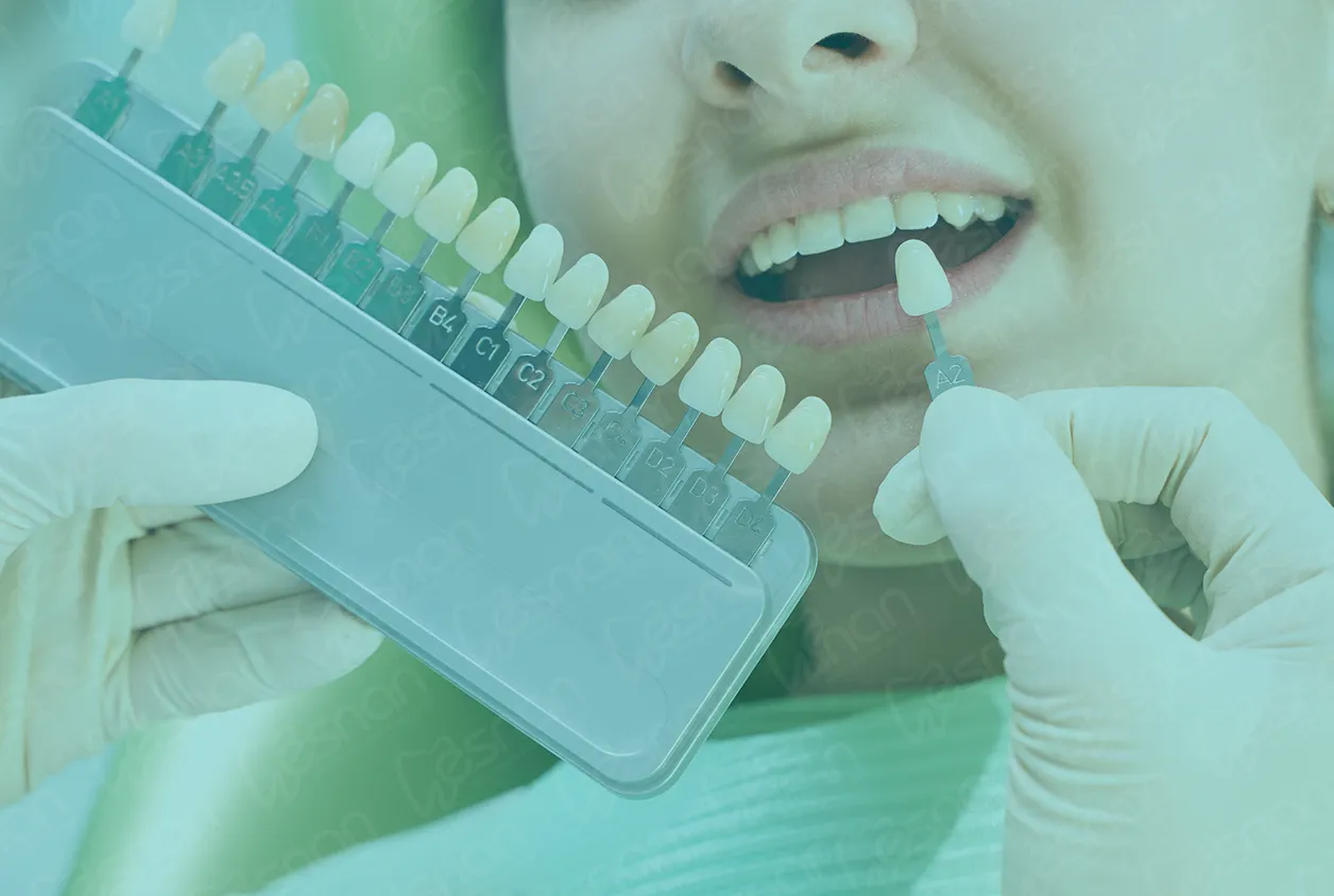 Decoding the dynamics of veneer color: Explore how factors like natural tooth shade, skin tone, and personal preferences influence the selection process.