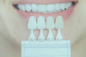 porcelain-laminate-veneers