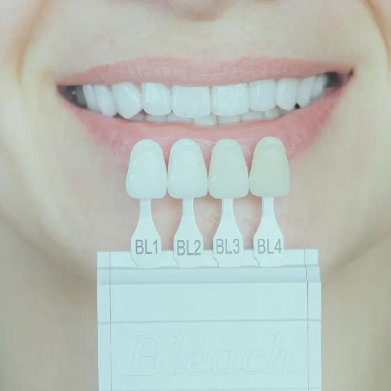 Achieve a stunning smile with porcelain laminate veneers. This advanced cosmetic dental solution enhances your teeth's appearance.