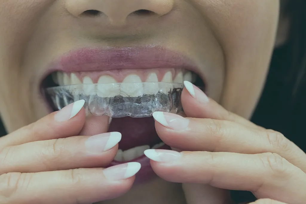 Discover ways to protect veneers in Turkey from excessive wear. Learn techniques and habits to maintain the durability and longevity of your dental veneers.