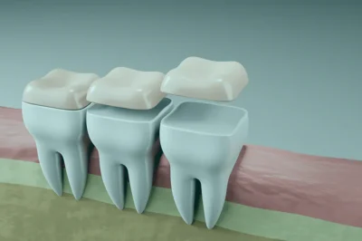 Dental crowns in Turkey have an option between zirconia and ceramic that may greatly affect the result of dental therapy.