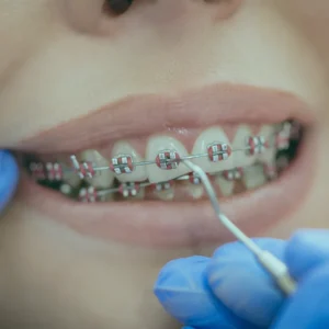 Correction of such dental issues is a primary objective of orthodontic treatment in Istanbul, which involves moving the crooked teeth and jaws.