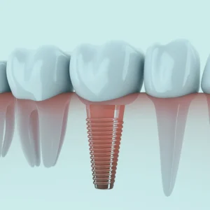 At the heart of modern dental implant in Istanbul lies digital dentistry, a realm where cutting-edge technologies converge to streamline treatment processes.