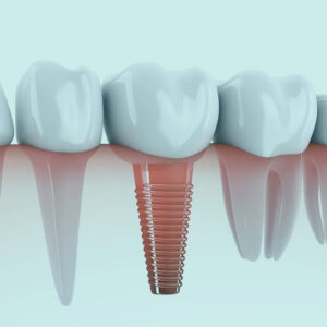 زراعة الاسنان في تركيا