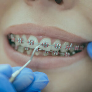 تقويم الأسنان في إسطنبول