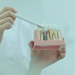 زراعة الأسنان في تركيا