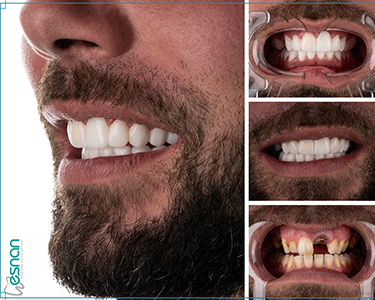 Discover superior dental implant in Istanbul. Experience advanced technology and expert care for a confident smile and lasting oral health.