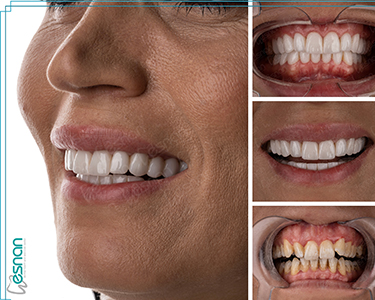 Explore the benefits of dental implant application: Enjoy restored functionality, improved aesthetics, enhanced oral health.