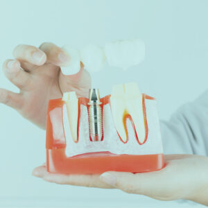 واقيات الفم لحماية الأسنان