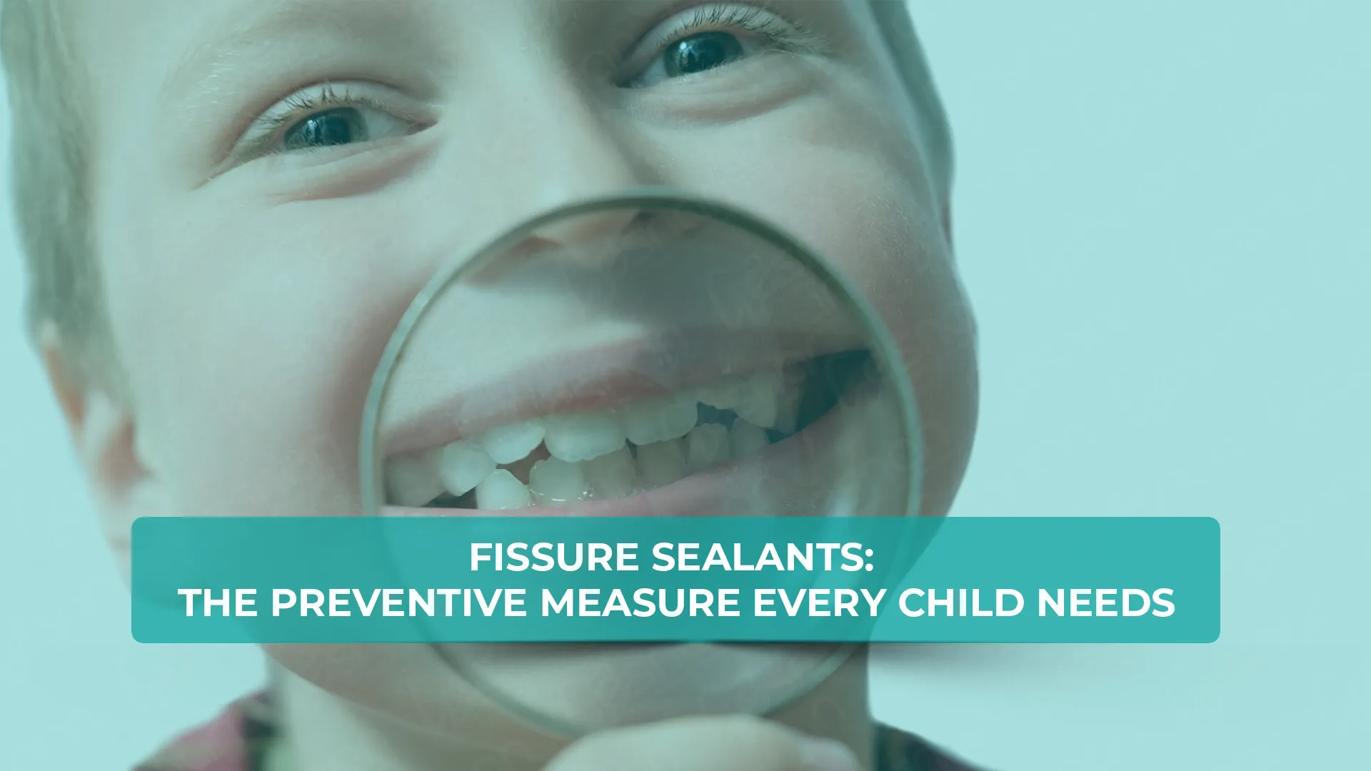 Fissure sealants: the preventive measure every child needs