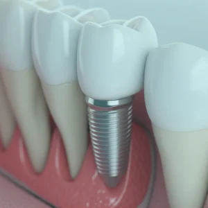 A smiling patient showing off their new dental implants, achieved at a modern clinic in Turkey, highlighting the advantages of dental tourism.