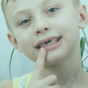 The procedure for applying fissure sealants