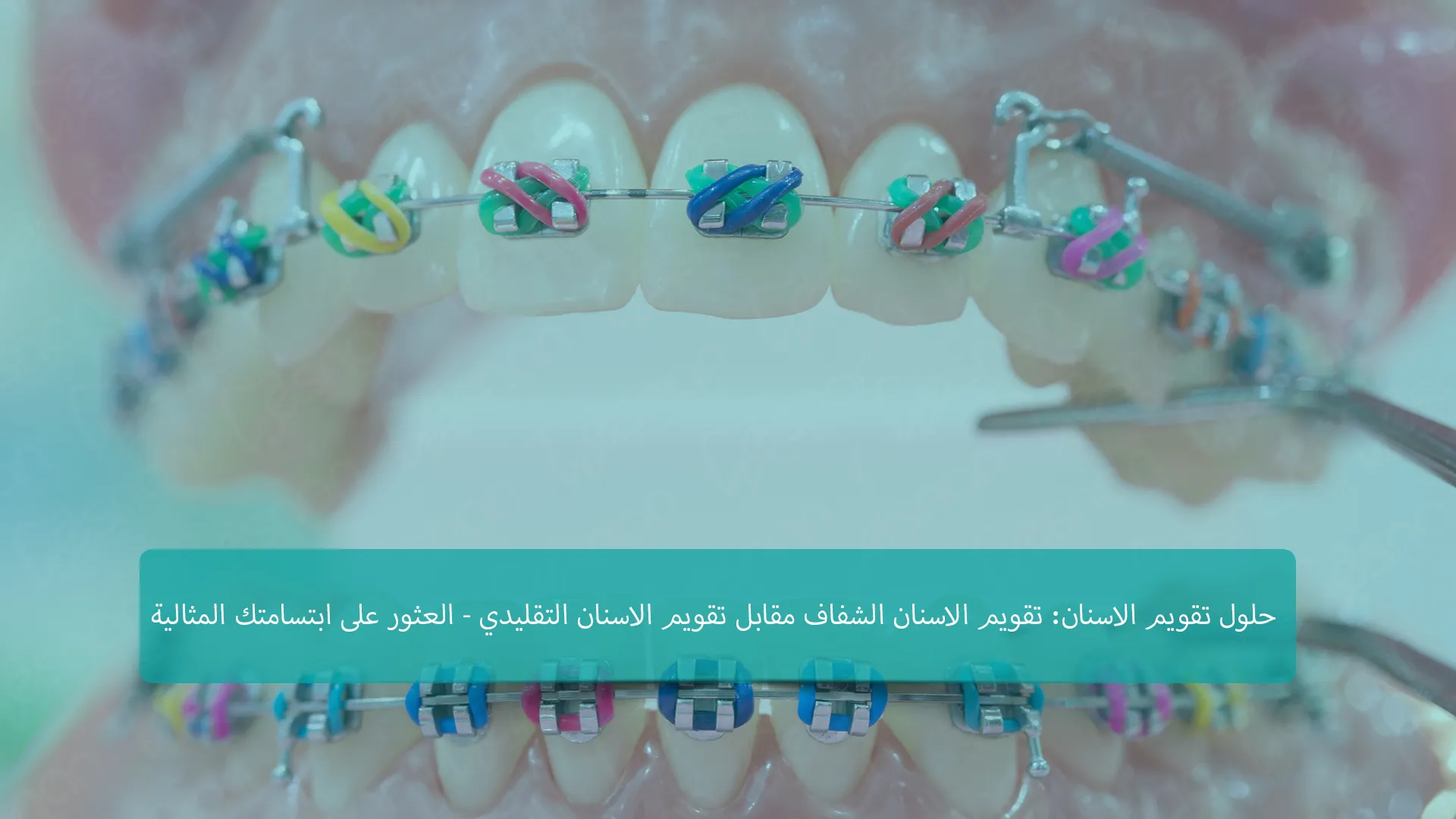 الاختيار بين التقويم الشفاف وتقويم الأسنان في تركيا؟ اعثر على حل ابتسامتك المثالي مع إرشادات الخبراء لدينا. استكشف الخيارات المصممة خصيصًا لاحتياجاتك