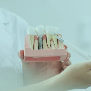 زراعة الأسنان: المخاطر والاعتبارات