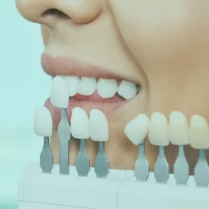 امرأة مبتسمة مع قشور الأسنان في تركيا