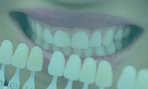 Veneer ve Kron Seçimi: Gülüş Dönüşümü İçin Kapsamlı Bir Rehber