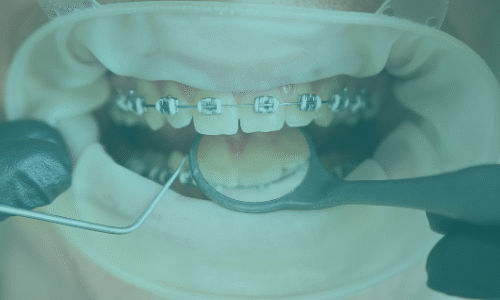 Ortodontik Tedavi Hakkındaki Yaygın Mitler