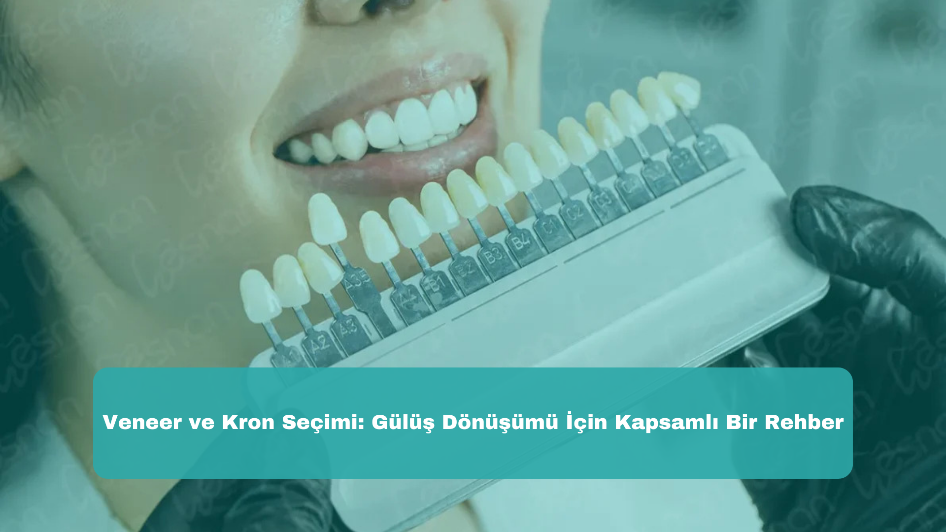 Veneer ve Kron Seçimi: Gülüş Dönüşümü İçin Kapsamlı Bir Rehber